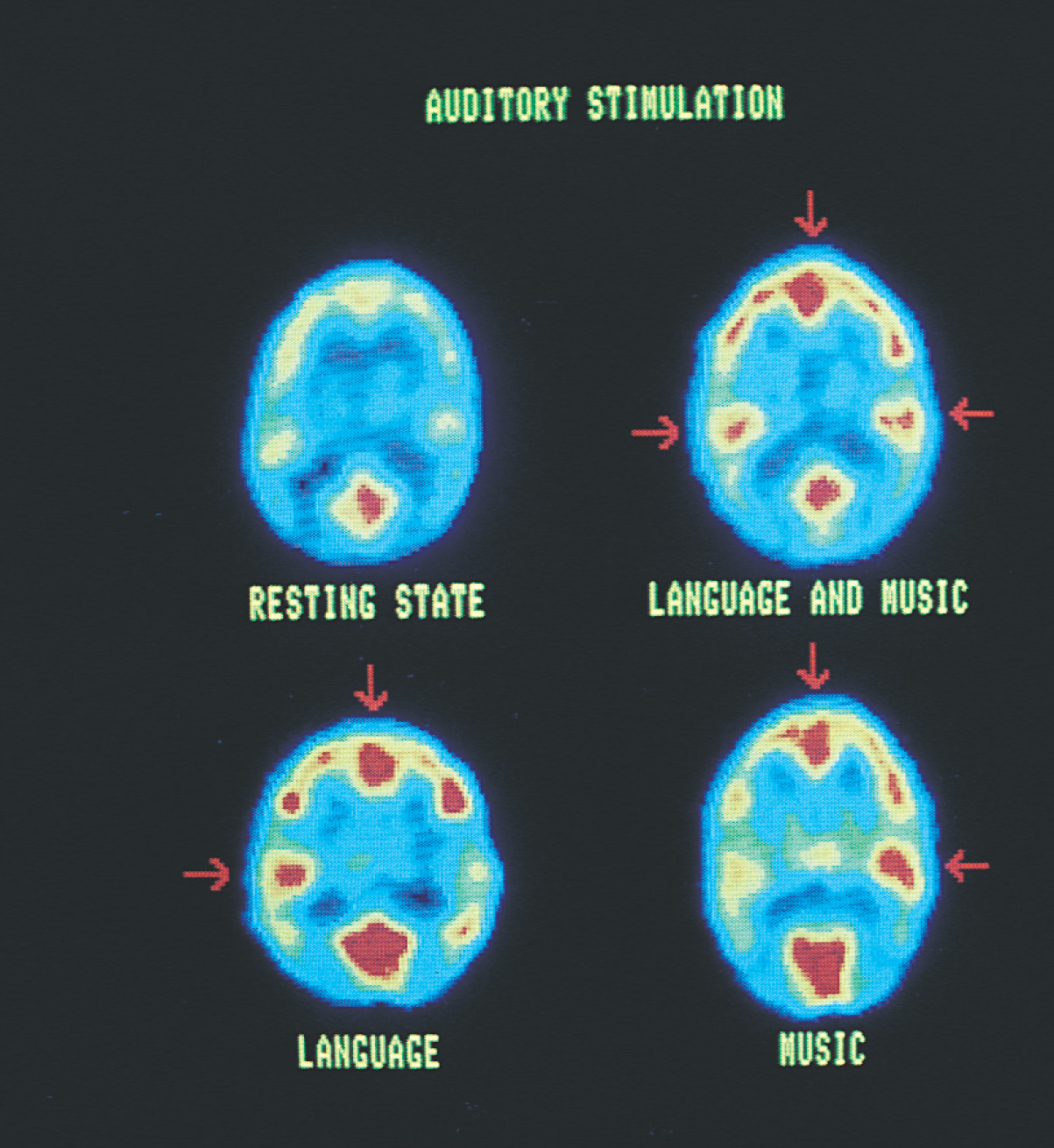 Brain scans: 4 views show auditory stimulation for a resting state, language and music, language only, and music only. 