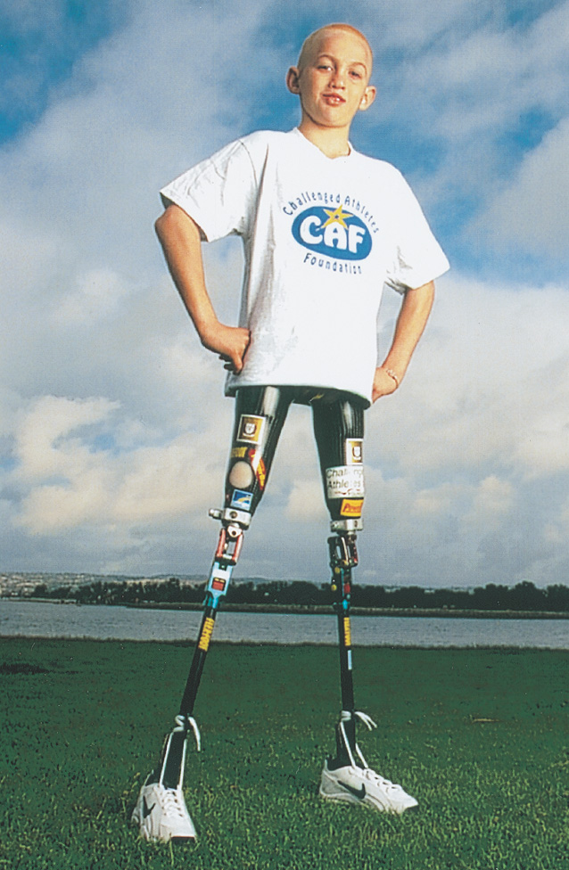 photo: a boy stands on prosthetic legs.